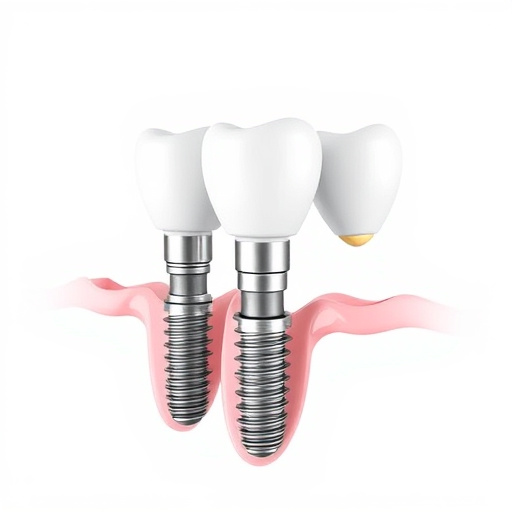 dental implants
