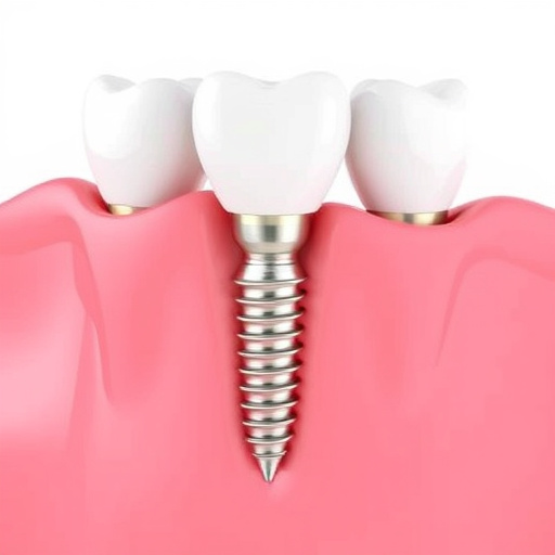 dental implants